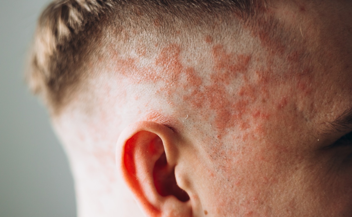 Possíveis problemas do transplante capilar